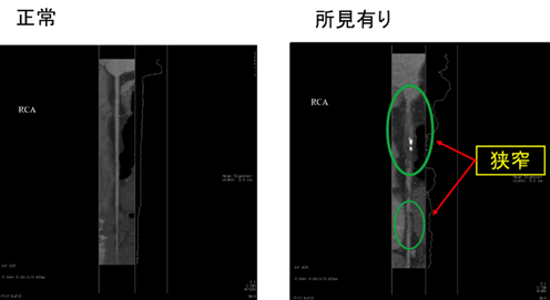 画像の再構成をおこなって血管を真っ直ぐに伸ばすと下記のようになりますの画像